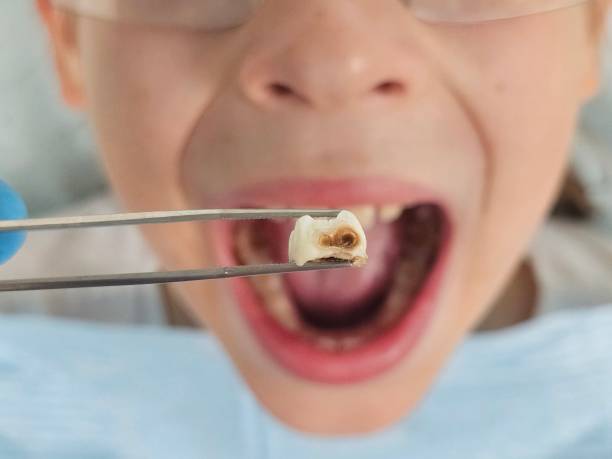 Best Emergency Tooth Extraction in Pulaski, TN